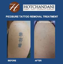 Through the years, we have gathered so many pictures and stories that it became simply unreasonable to keep it all to ourselves. Tattoo Removal Green Bay Appleton Wi Hotchandani Laser Aesthetic
