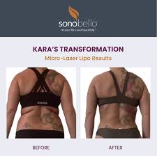 Sono Bello Before And After Could I Be Next Pattie Cordova Before And After Liposuction Liposuction Laser Liposuction