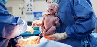 Baby Being Born Via Caesarean Section Caesarean Section C Section Post Partum Workout