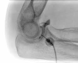 Image result for Elbow Joint Injection
