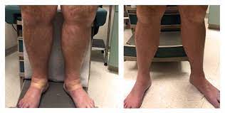 Treatment for dvt usually involves taking anticoagulant medicines. Deep Vein Thrombosis Treatment Interventional Radiology Penn Medicine