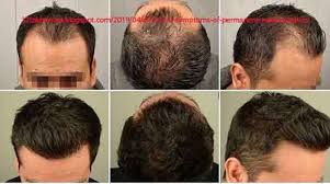 Hair Prosthesis Hair Implants Hair Loss Symptoms Permanent Hair Extensions