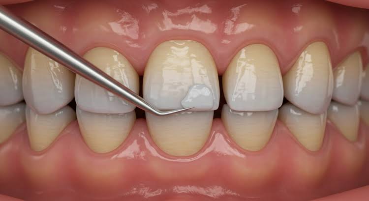 Does Composite Bonding Damage Enamel? - Tooth Club