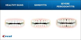 We did not find results for: Cabut Gigi Ketika Hamil Bahaya Ataupun Tidak