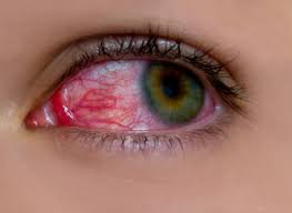 Conjunctivitis Prevention: How To Avoid Contracting Pink Eye