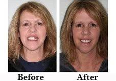 A partial denture is placed to fill up the empty space in the teeth. Dentures Partials Lakleland Kawveh Nofallah Dmd