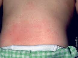 Image result for skin rash similar to scabies