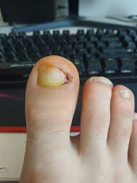 Image result for Akutní zánět nehtového lůžka