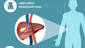 However, as you will see, depending on the cause of kidney pain, kidney disease and infections can according to the national kidney foundation, pain below the rib cage or on your sides could be coming from your kidneys. Liver Cancer Signs Symptoms And Complications