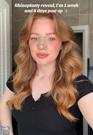 Rhinoplasty Journey: My 8-Day Post-Op Reveal