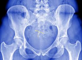 Cramps were really bad tuesday night, then i started bleeding wednesday night with little to. Iud Complications Ob Gyns Discuss Expulsion And Perforation Self