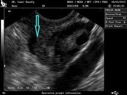 We did not find results for: Prediction Of Endometriosis By Transvaginal Ultrasound In Reproductive Age Women With Normal Ovarian Size Sciencedirect