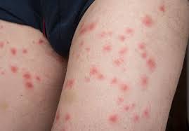 Image result for flea bites