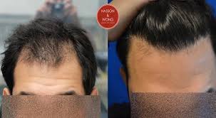 Corticosteroid, betamethasone and hair loss about betamethasone: Corticosteroid Betamethasone And Hair Loss Hairsite Com
