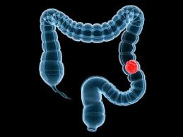 If you're over 50 and putting off a colonoscopy because you don't have symptoms, you're defeating the purpose of the colonoscopy. A New Look At Colon Cancer Screening Harvard Health