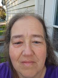 Are others experiencing severe eye issues due to seasonal allergies?