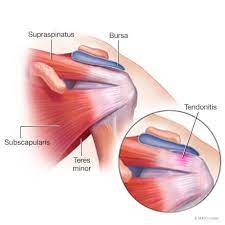 Shoulder muscles and shoulder tendons. Rotator Cuff Tendonitis And Tears Sports Medicine