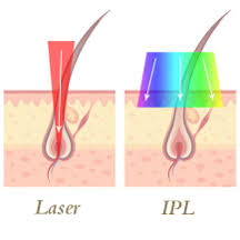Light pulses are used to damage hair follicles, and impair their ability to grow hair. Ipl Vs Laser Smoothskin Gold