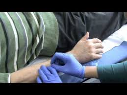 Trigger Point Dry Needling For Lateral Epicondylitis Dry Needling Massage Therapy Trigger Points
