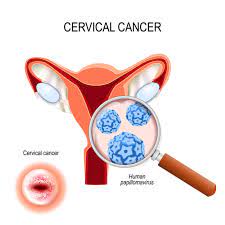 Cervical cancer can be easily detected if you conduct regular pap smear tests. New Screening Method For Cervical Cancer May Improve Early Diagnosis