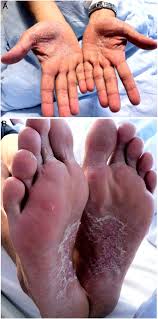 Image result for Secondary Syphilis