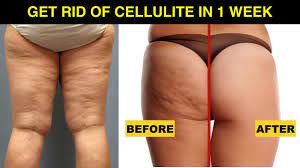 How do i get rid of the cellulite? How To Get Rid Of Cellulite On Thighs And Bum Fast At Home Just 1 Week 100 Naturally Youtube