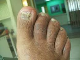 Image result for onychomycosis