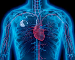 What are the different types of pacemakers? Types Of Pacemakers Pulse Cardiology