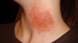 Hamburger di spinaci e pollo; Sintomi Dell Allergia Al Nichel Quali Sono E Dove Si Manifestano