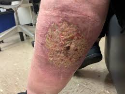 Image result for Pyoderma Gangrenosum