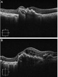 How are retinal tears treated? The Optical Coherence Tomography Oct Images Of 78 Year Old Male With Download Scientific Diagram