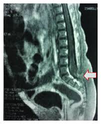 Image result for Spinal Dysraphism