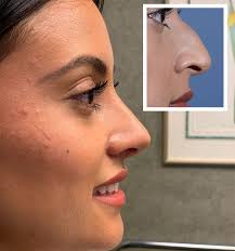 Dr Spencer Cochran (@dallas_rhinoplasty_center) · Instagram 照片和视频