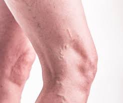 Because a clot can block blood flow in your leg, it may cause a backup of blood. Top Warning Signs Of Deep Vein Thrombosis Dr White S Vein Center And Morgantown Sculpsure Clear Ink Pllc Vein Specialists