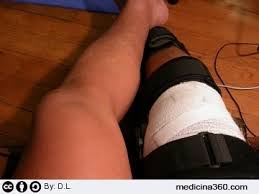 Per i sollevatori di pesi, una delle zone del corpo che riceve maggior stress è la zona del ginocchio. Artroscopia Cos E Vantaggi Rischi Ed Interventi Comuni