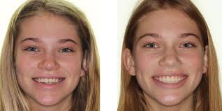 Damon Q2 brackets — for variable torque in treatment