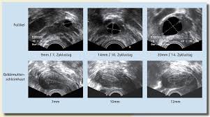 Medical information for ovitrelle including its dosage, uses, side, effects, interactions, pictures and treatment with ovitrelle should be performed under the supervision of a physician experienced in the. Ivf Saar Kontrollzyklus