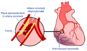 Check spelling or type a new query. Infarctul Miocardic