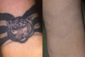 You're other treatments sounded down right scary. Laser Tattoo Removal Virginia Beach David H Mcdaniel Md Laser Center And Medical Spadavid H Mcdaniel Md Laser Center And Medical Spa