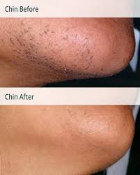 Add 2 tbsp milk, 1 tbsp gelatine and a drop of lime juice to a bowl and mix well. Transgender Permanent Laser Hair Removal