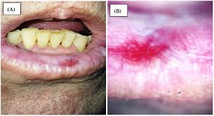 Image result for lichen planus on tongue)