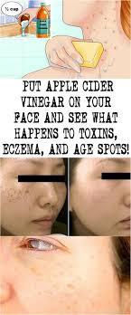 Put Apple Cider Vinegar On Your Face And See What Happens To Toxins Eczema And Age Spots Apple Cider Vinegar Cider Vinegar Apple Cider Vinegar Remedies