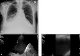 Tubercular pleural involvement may be in the form of pleural effusion, pleural thickening, empyema, bronchopleural or pleurocutaneous fistula, or calcifications. Clinical Importance Of Echogenic Swirling Pleural Effusions Lane 2016 Journal Of Ultrasound In Medicine Wiley Online Library