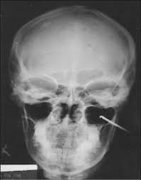 Image result for Sinus X Ray