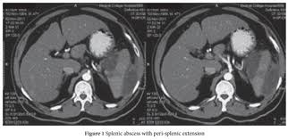 Image result for Splenic Abscess