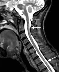 The downward line of the 't' is a transverse process of the vertebra. Diagnostic Approach To Intrinsic Abnormality Of Spinal Cord Signal Intensity Radiographics