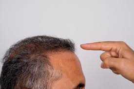 Low levels of iron, vitamins such as b complex, and proteins in the diet and vitamin d deficiency may lead to the. How To Treat Hair Loss