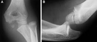 Image result for Elbow Dislocation