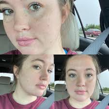 I had a dream that my face is full of big big pimples and am trying to  remove them but they are very Strong