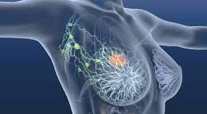 Do you know everything about breast cancer? Breast Cancer Awareness Month Quiz On Medicine